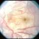 SLE Vasculitis